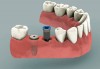 .Имплантация зубов - современно и надежно, долговечно!.