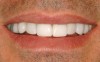 .Металлокерамика: красивые и функциональные зубные протезы.