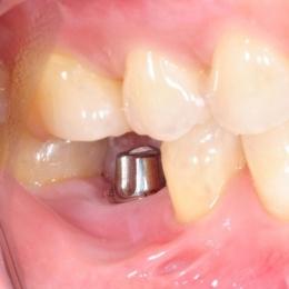 Имплантация зубов - современно и надежно, долговечно!