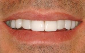 Металлокерамика: красивые и функциональные зубные протезы